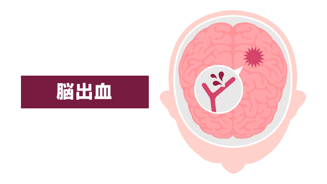 脳出血
