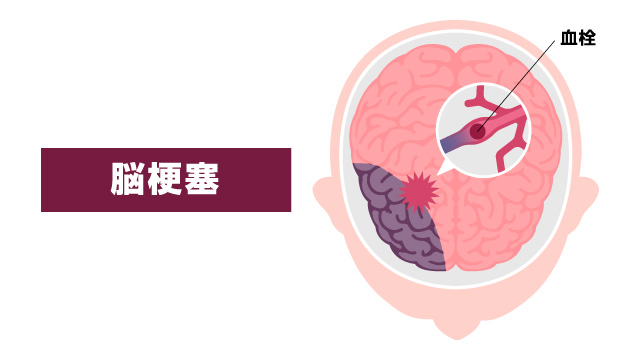 脳梗塞