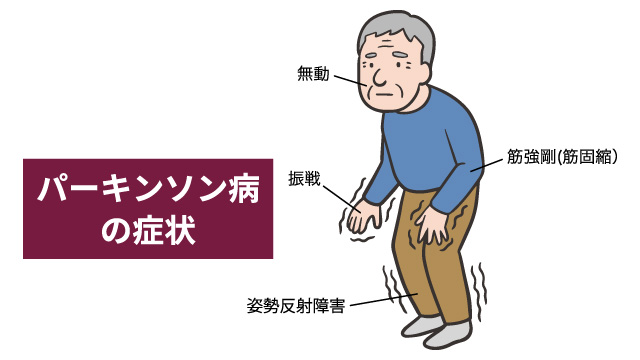 パーキンソン病(PD)