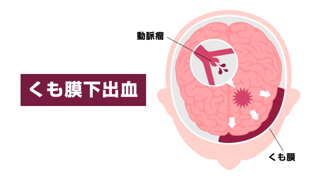 くも膜下出血